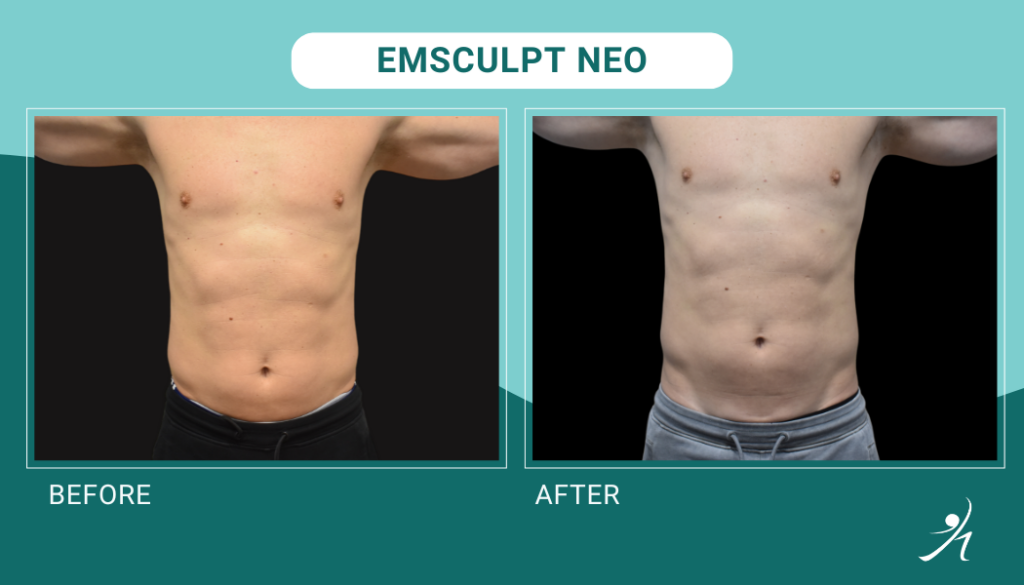 Emsculpt Neo in Chicago