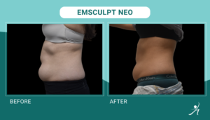 Emsculpt Neo in Chicago