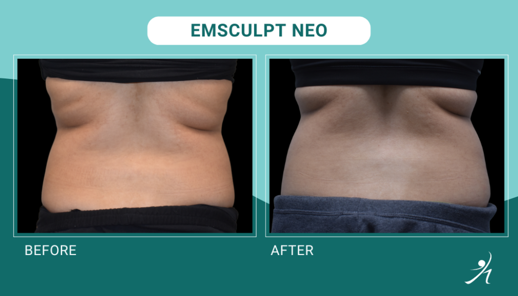 Emsculpt Neo in Chicago