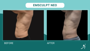 Emsculpt Neo in Chicago