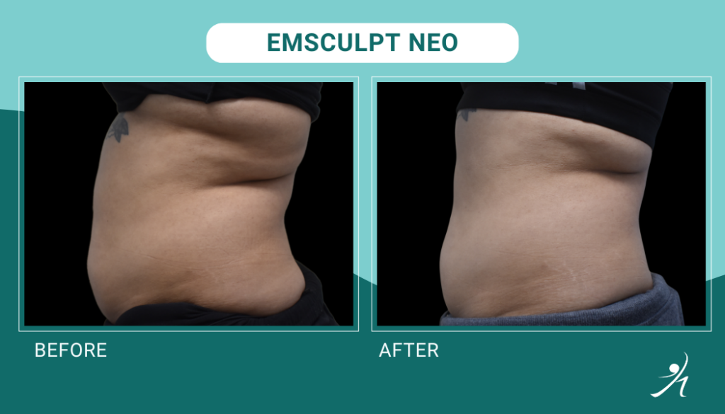 Emsculpt Neo in Chicago