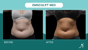 Emsculpt Neo in Chicago