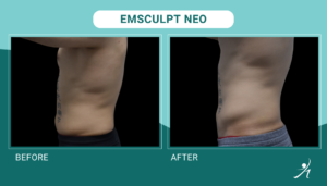 Emsculpt Neo in Chicago