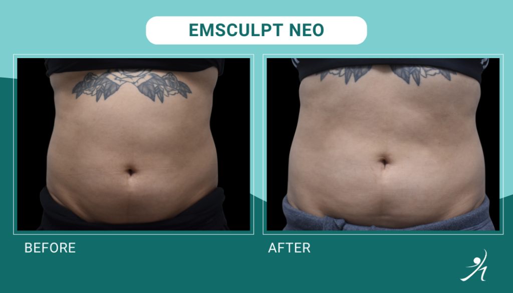 Emsculpt Neo in Chicago