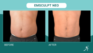 Emsculpt neo chicago before and after